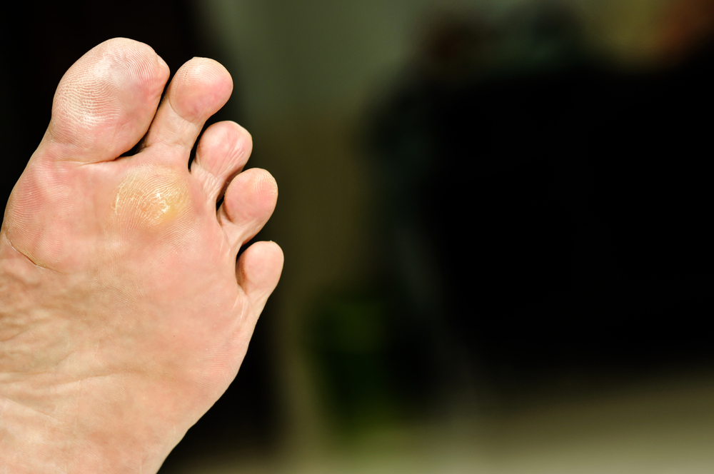 common warts on feet