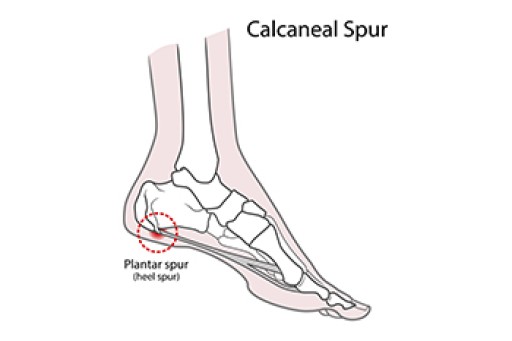 Risk Factors for Developing Heel Spurs