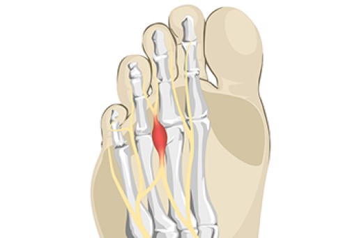 Morton's Neuroma