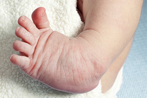 Congenital Foot Problems