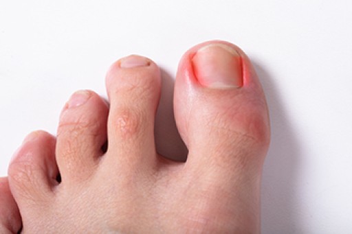 How Ingrown Toenails Can Develop