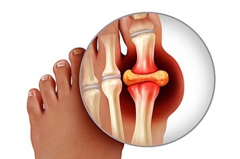 Causes and Symptoms of Gout