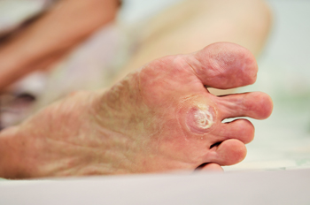 Are Plantar Warts Contagious